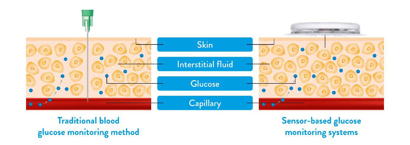 a comparison of a needle and a sensor monitoring glucose through the skin.